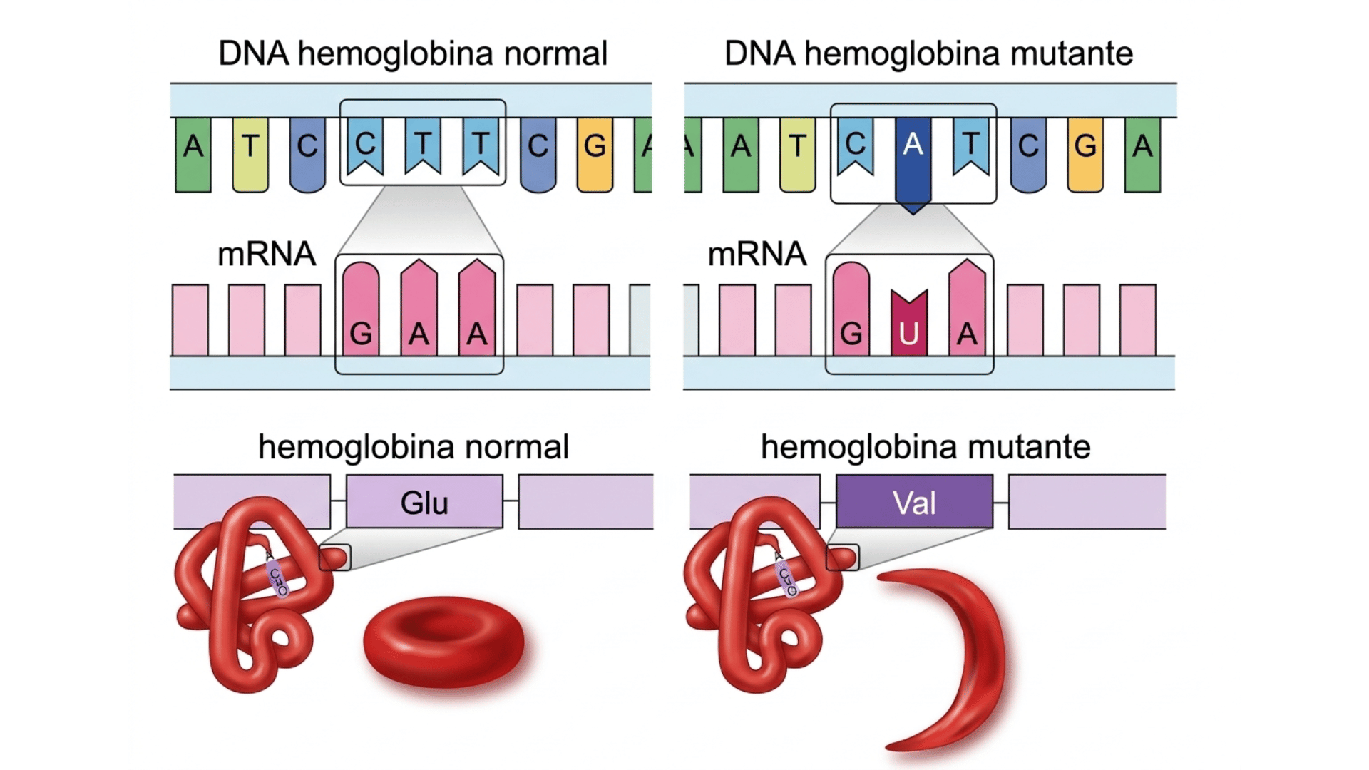 Um diagrama científico em cores comparando a genética e a biologia da hemoglobina normal versus a hemoglobina mutante (célula falciforme). O diagrama ilustra quatro etapas principais de cima para baixo: 1. O gene do DNA (mostrando o códon CTT para normal e CAT para mutante), 2. O mRNA resultante (códon GAA para normal e GUA para mutante), 3. A sequência de aminoácidos da proteína hemoglobina (Glu para normal e Val para mutante) com um modelo de proteína 3D e 4. A forma do glóbulo vermelho resultante (biconcavo para normal e em forma de foice para mutante). Todos os textos estão em português.