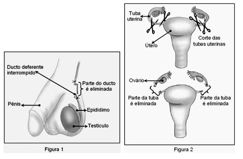 vasectomia e ligação tubária